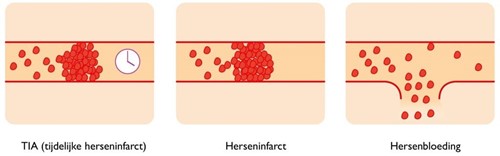 Uitleg TIA, herseninfarct, hersenbloeding