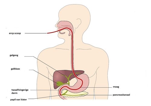 ERCP galblaasonderzoek